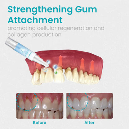 🦷🔥Last Day Promotion 80% OFF-NESLEMY™ Gum Shield Therapy Gel